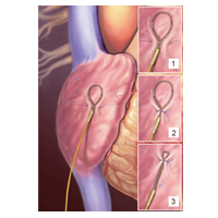 Temporary Pacing Wires