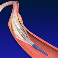 Bare Metal Stents